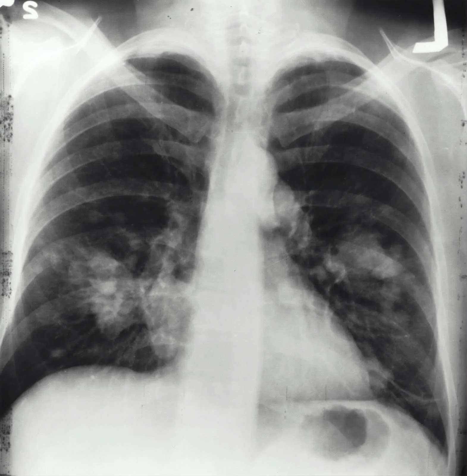 What’s Alpha-1 Antitrypsin Deficiency